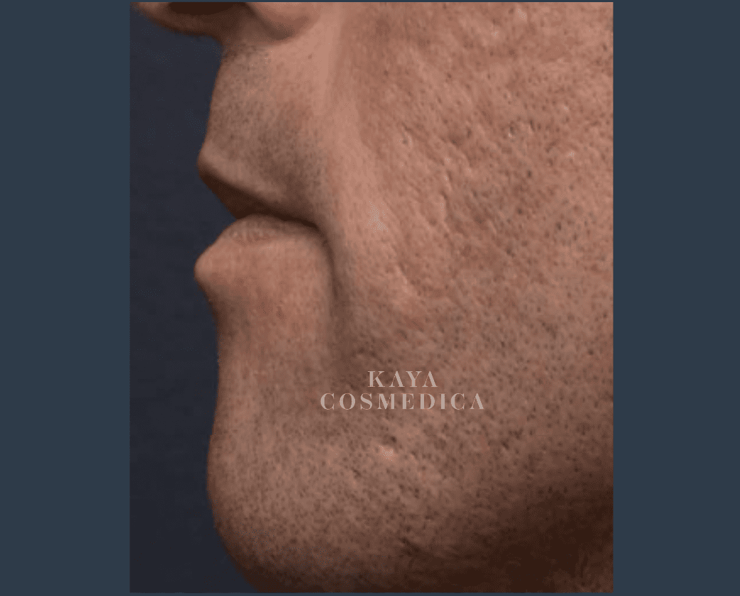 Close-up of a person's profile showing the lower half of the face, focusing on the mouth and chin against a dark background, highlighting acne treatment, with the text "kaya cosmedica