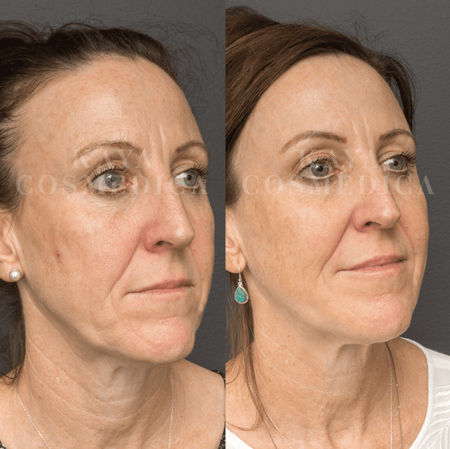 Before and after side-profile photos of a middle-aged woman showing skin rejuvenation in facial skin, likely after cosmetic treatment. She has brown hair, wears earrings, and has a subdued expression.