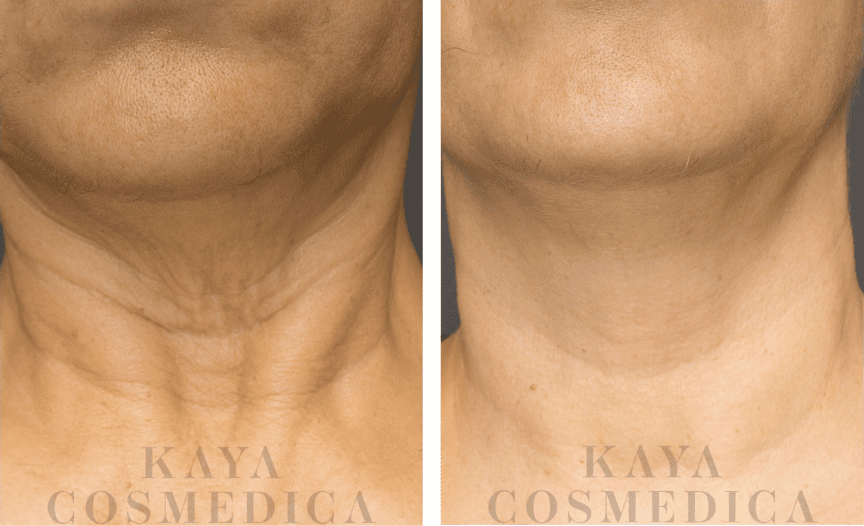 Before and after close-up images of a neck treatment, showing reduced wrinkles and smoother skin after the treatment, with "kaya cosmedica" visible in both images. The treatment enhances collagen production.