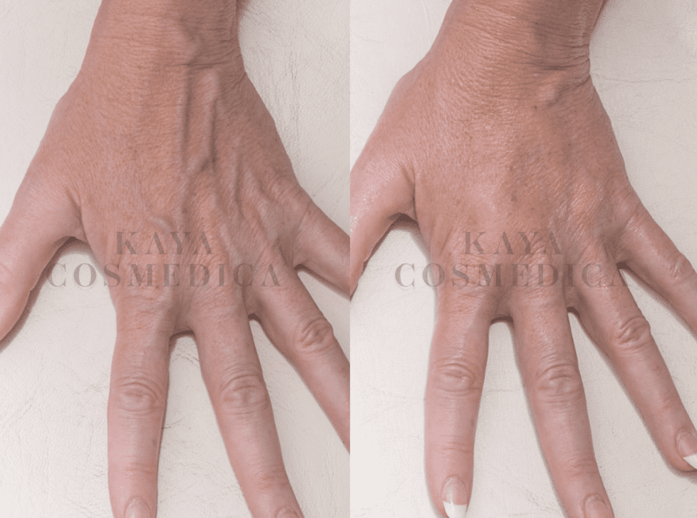 Before and after comparison of a hand showing collagen production treatment results. The left image shows more visible wrinkles and veins, while the right shows smoother skin. Text "kaya cosmedica" is water