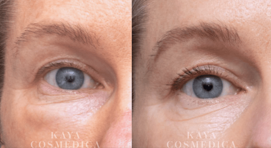 Close-up comparison of a person's eyes before and after cosmetic treatment, showing reduced wrinkles and clearer skin in the after image due to facial filler correction. Both images are labeled "Kaya Cosmedica
