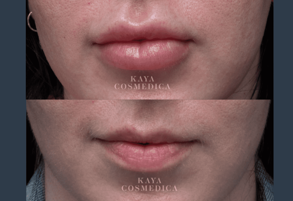 Before and after close-up images of a person's lips, demonstrating the results of a facial filler treatment. The logo "kaya cosmedica" is visible on both images.