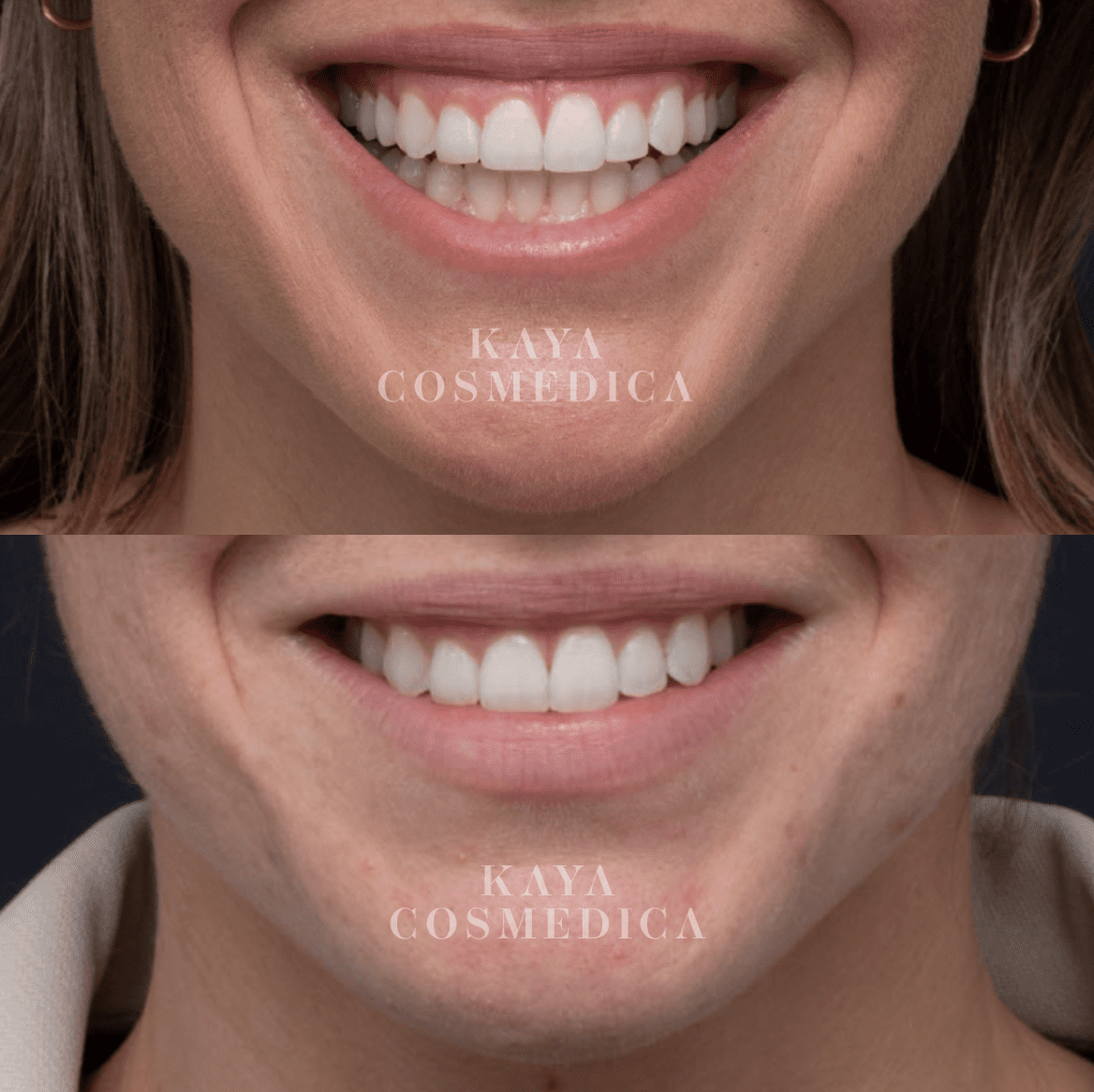 Before and after close-up photos of a smiling person's mouth showing teeth whitening results from a cosmetic procedure. The image includes the logo "Kaya Cosmedica" on both photos.