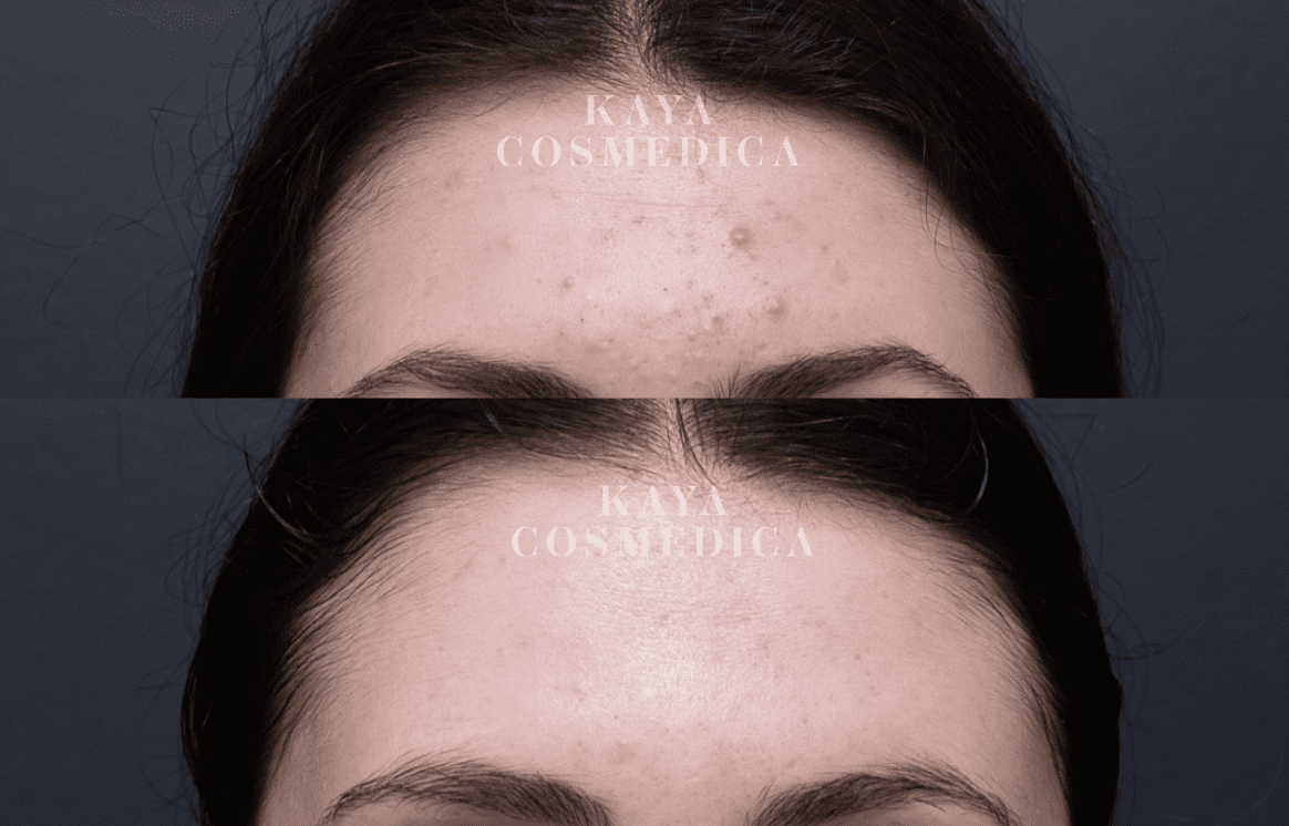 Before and after comparison of a forehead receiving acne treatment. The top image shows skin with acne, and the bottom image shows clear, improved skin condition. Both images have "Kaya Cosmedica