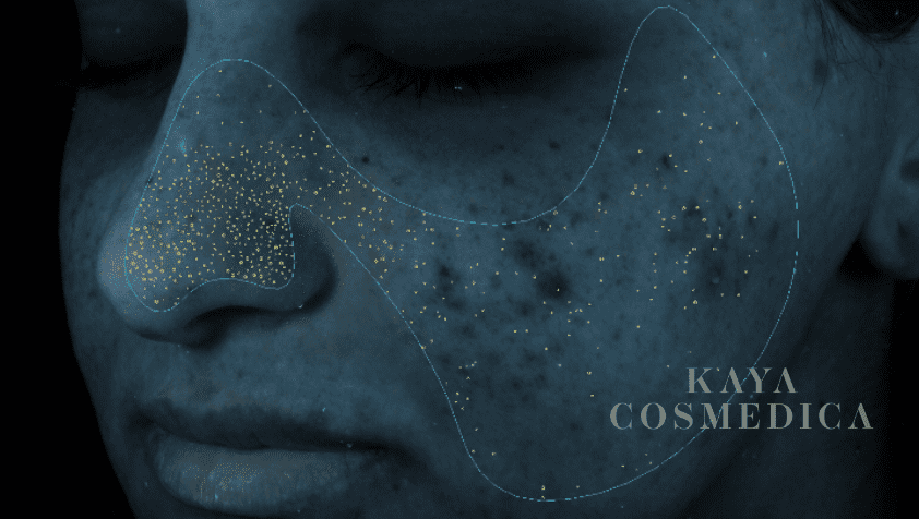 Close-up of a person's face focusing on the nose and cheeks, overlaid with a digital constellation pattern and the text "kaya cosmedica." The skin texture is visible and detailed, highlighting