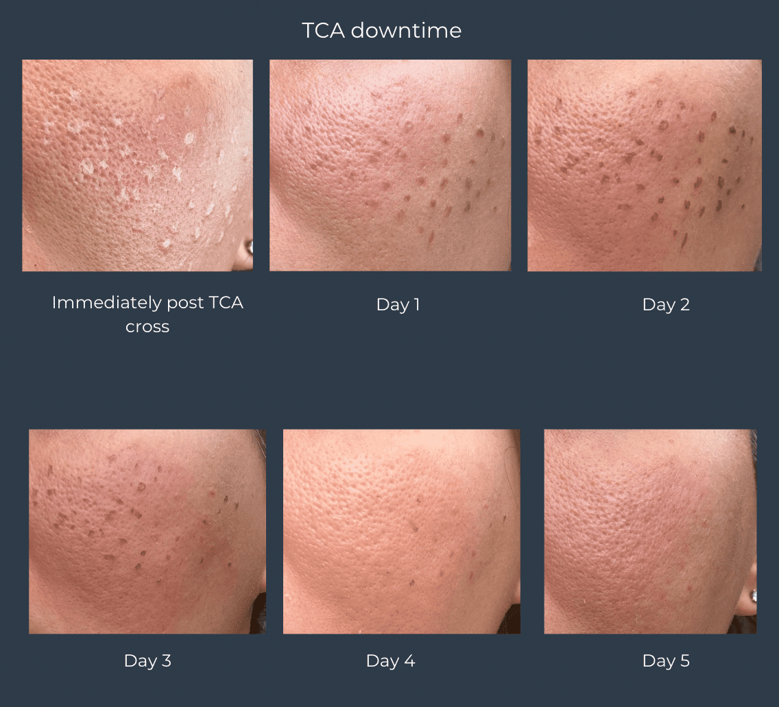 A series of six close-up images displaying the progress of skin healing over five days after an acne treatment, showing changes from redness and scabbing to gradual healing.