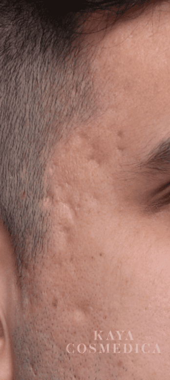 Close-up of a person's forehead showing skin texture with visible pores and minor acne scarring from past acne treatment. Part of an eyebrow and hairline is visible in the top left corner. Text 