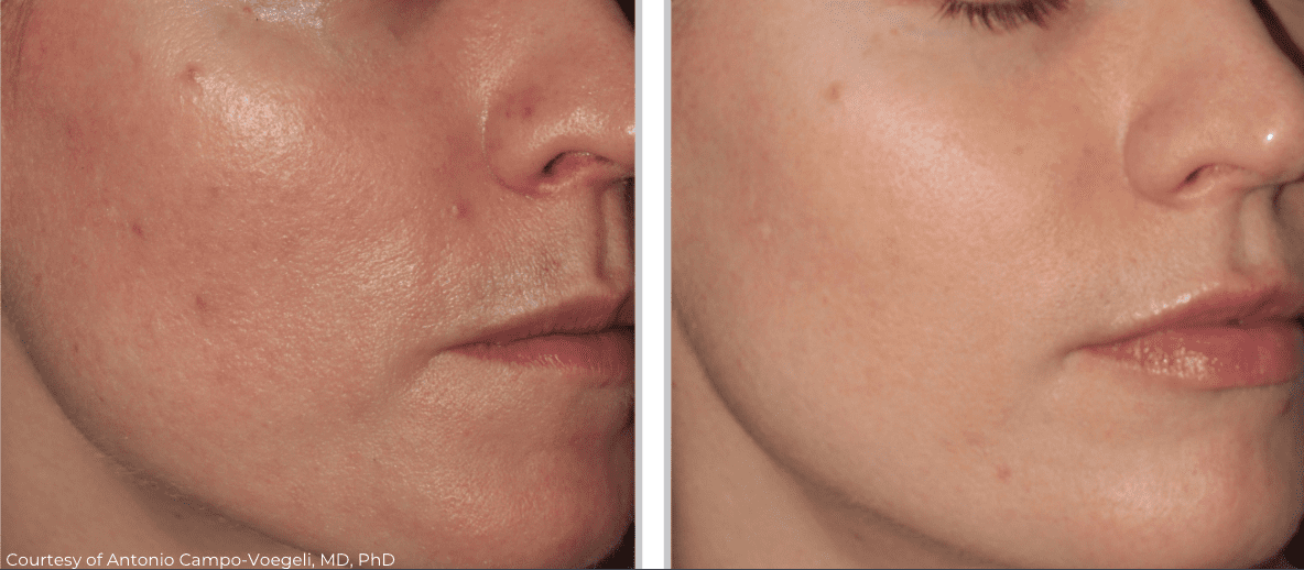 Side-by-side close-up images of a person's cheek before and after treatment, showing reduced acne and smoother skin texture on the right, achieved using silk laser technology.