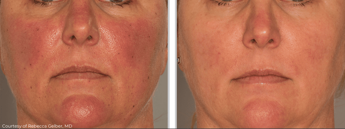 Before and after close-up photos of a woman's face showing improvement in skin texture and reduction in redness and blemishes after Clear Silk Laser treatments.