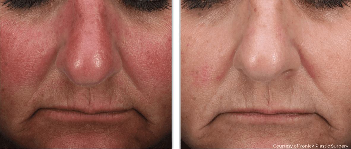 Before and after close-up photos of a person's nose, showing a significant reduction in redness and improved skin texture post Clear Silk Laser treatment.