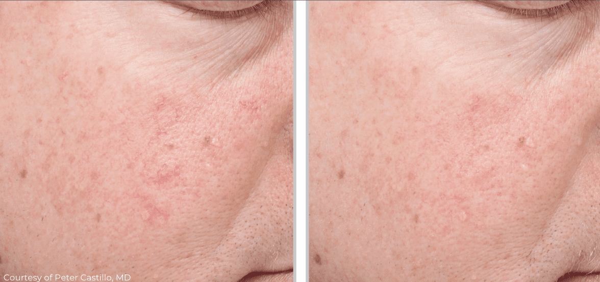 Before and after close-up photos of a person's cheek following Clear V Laser treatment showing improvement in skin condition, with reduced redness and clearer skin texture. The images are labeled as courtesy of Peter Castillo