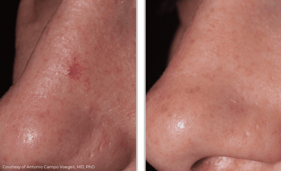 Side-by-side comparison of a nose with visible skin improvement: the left image shows a prominent red scar, while the right image displays the same nose with the scar less noticeable after vascular treatment, and skin