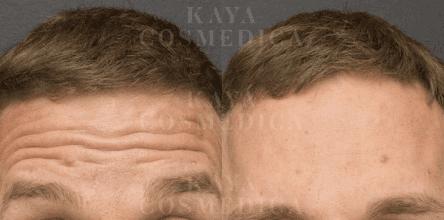 Close-up image showing the forehead of a person before and after wrinkle treatment. The left side has visible wrinkles, while the right side appears smoother and clearer, marked "Kaya Cosmedica.