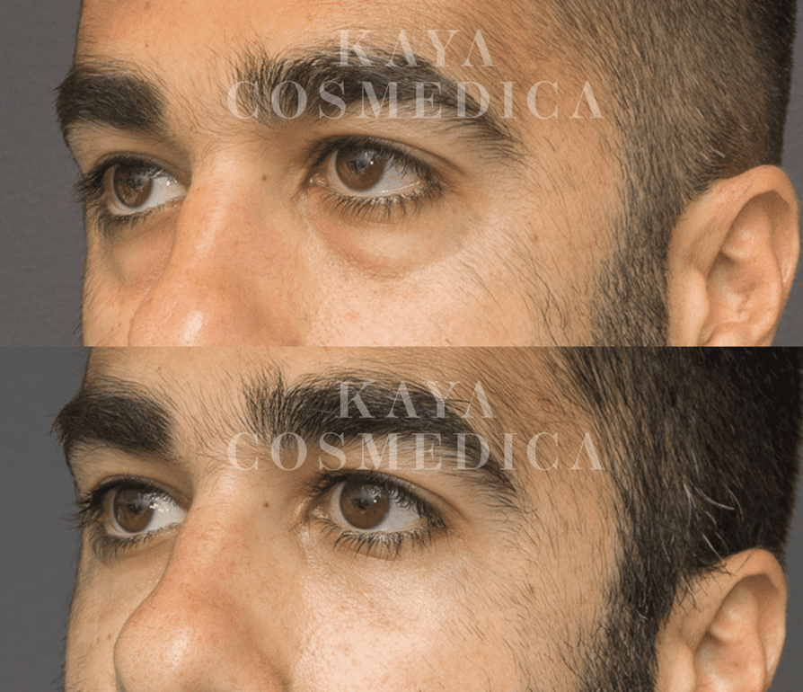 Before and after close-up photos of a man's eyes showcasing the results of dermal fillers. The top image shows slight under-eye bags, while the bottom image shows reduced puffiness and smoother skin