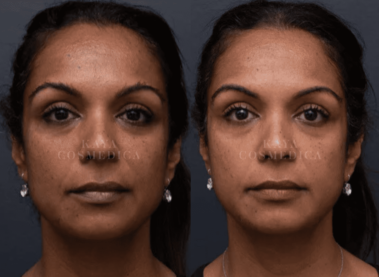 Before and after comparison of a woman's face showing skin rejuvenation. The left image displays more spots, while the right image shows clearer skin. Both photos have a gray background.