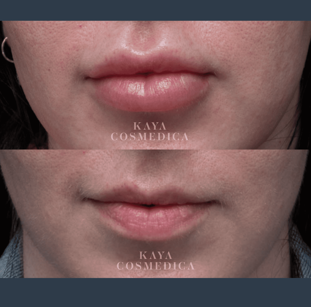 Close-up of a woman's lips before and after dermal filler treatment, shown in a split comparison. The top image displays slightly thinner lips, while the bottom image shows fuller lips with the logo