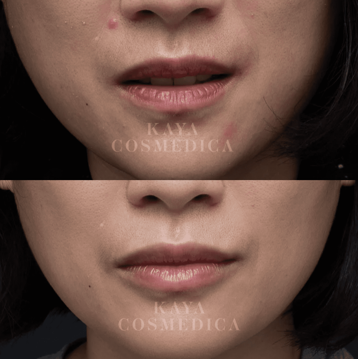 Close-up comparison of a woman's lips before and after treatment, labeled "kaya cosmedica." The top image shows lips with mild dryness and imperfections; the bottom image shows improved,