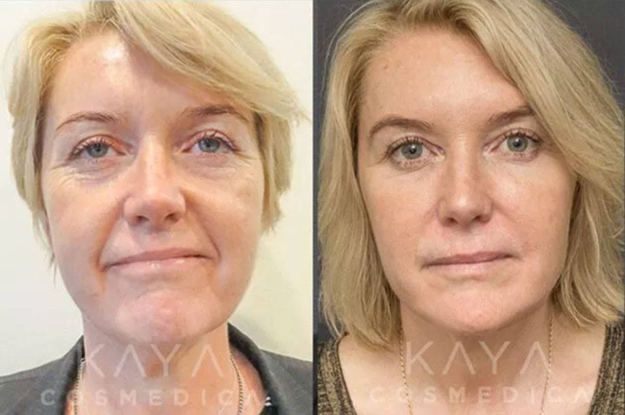 Before and after comparison of a woman's facial cosmetic treatment, highlighting visible improvements in skin texture and reduction of fine lines. each image features the same woman with varying skin clarity.