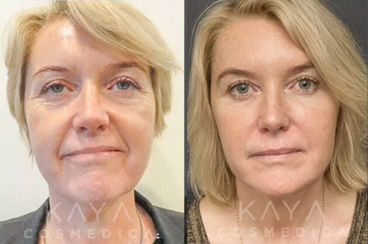 Before and after comparison of a woman's facial cosmetic treatment, highlighting visible improvements in skin texture and reduction of fine lines. each image features the same woman with varying skin clarity.
