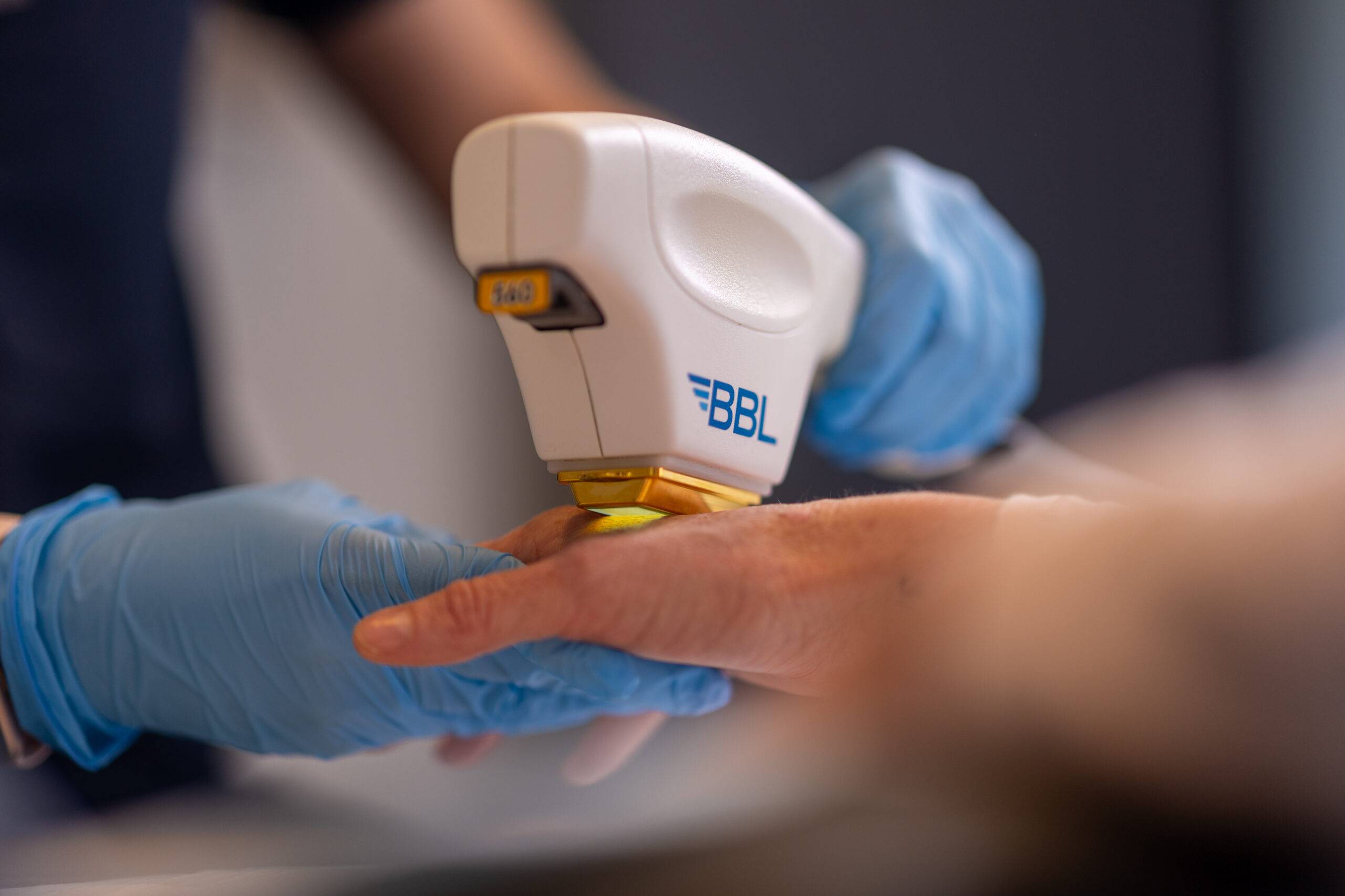 A healthcare professional in blue gloves uses a handheld bbl device for hand rejuvenation on a patient's hand during a medical examination.