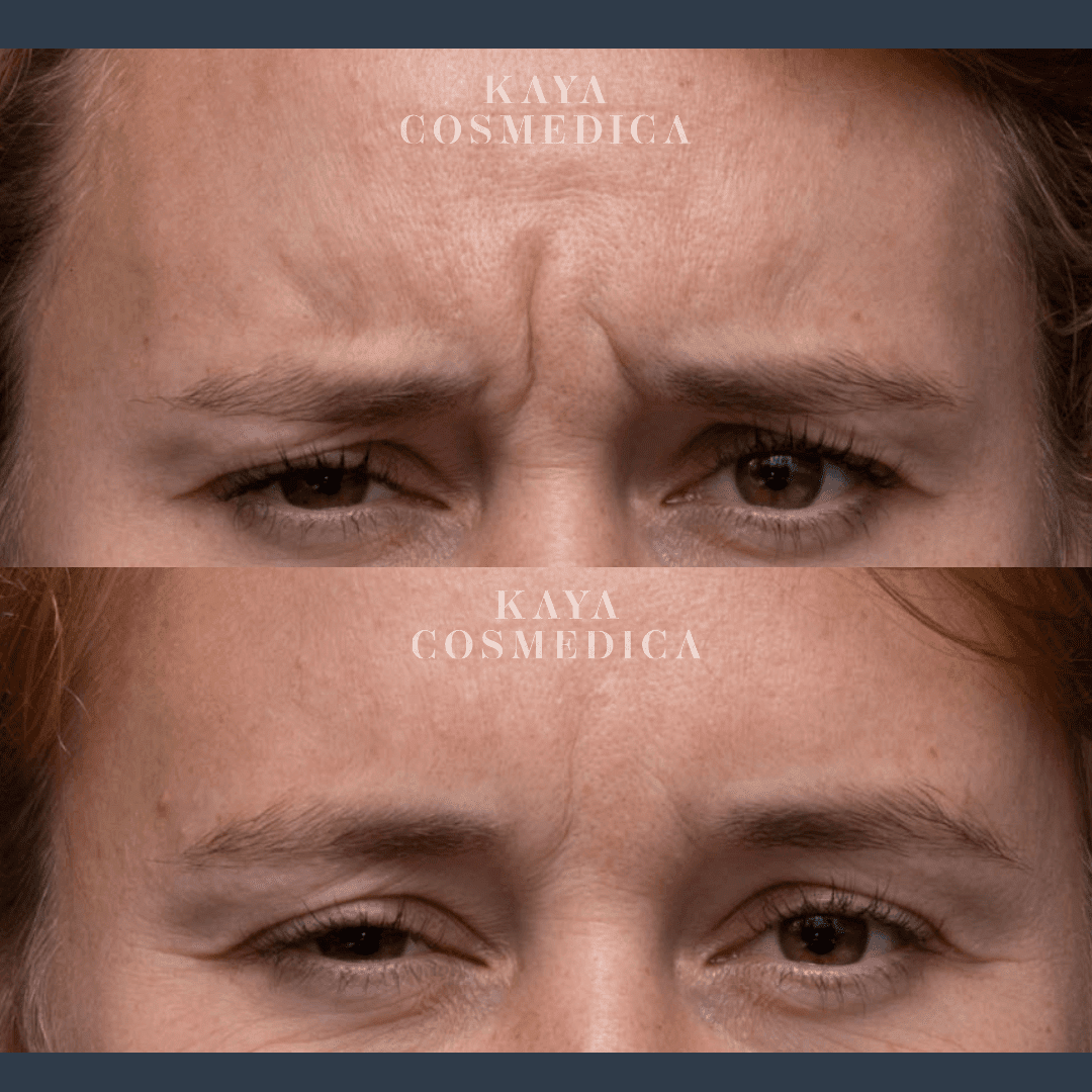 Close-up comparison of a woman's face, showing forehead wrinkles before and after anti-wrinkle treatment, with the words "kaya cosmedica" displayed at the top of each image.