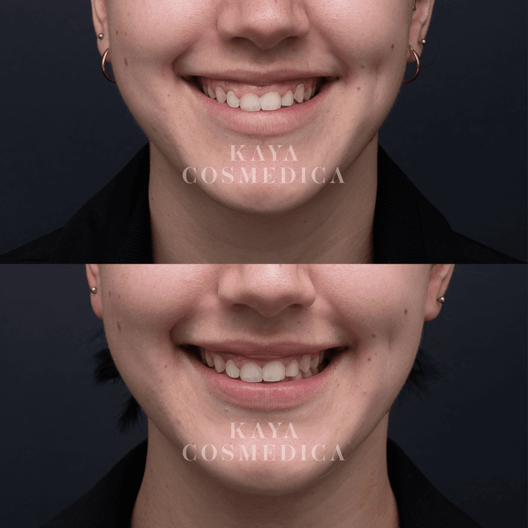 Before and after comparison of an anti-wrinkle dental treatment, showing a close-up of a person's smile with enhanced teeth alignment and whiteness, against a dark background with "kaya cos