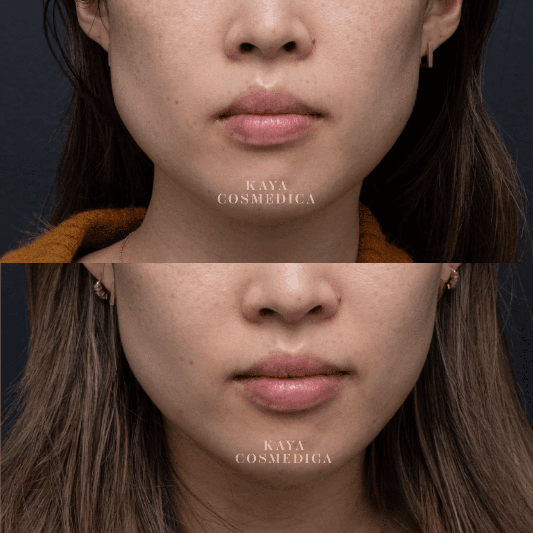 Close-up before and after comparison images of a woman's lower face showing anti-wrinkle improvement in skin texture and clarity, with the logo "kaya cosmedica" displayed on both images.