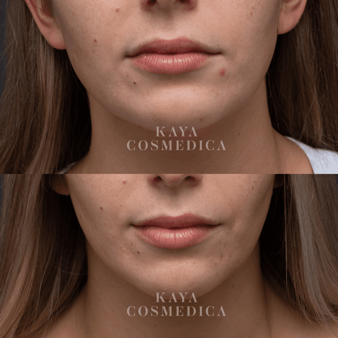 Before and after close-up images of a woman's lower face, showing improvement in skin texture and reduction in acne as well as wrinkle treatment. The words "kaya cosmedica" are labeled
