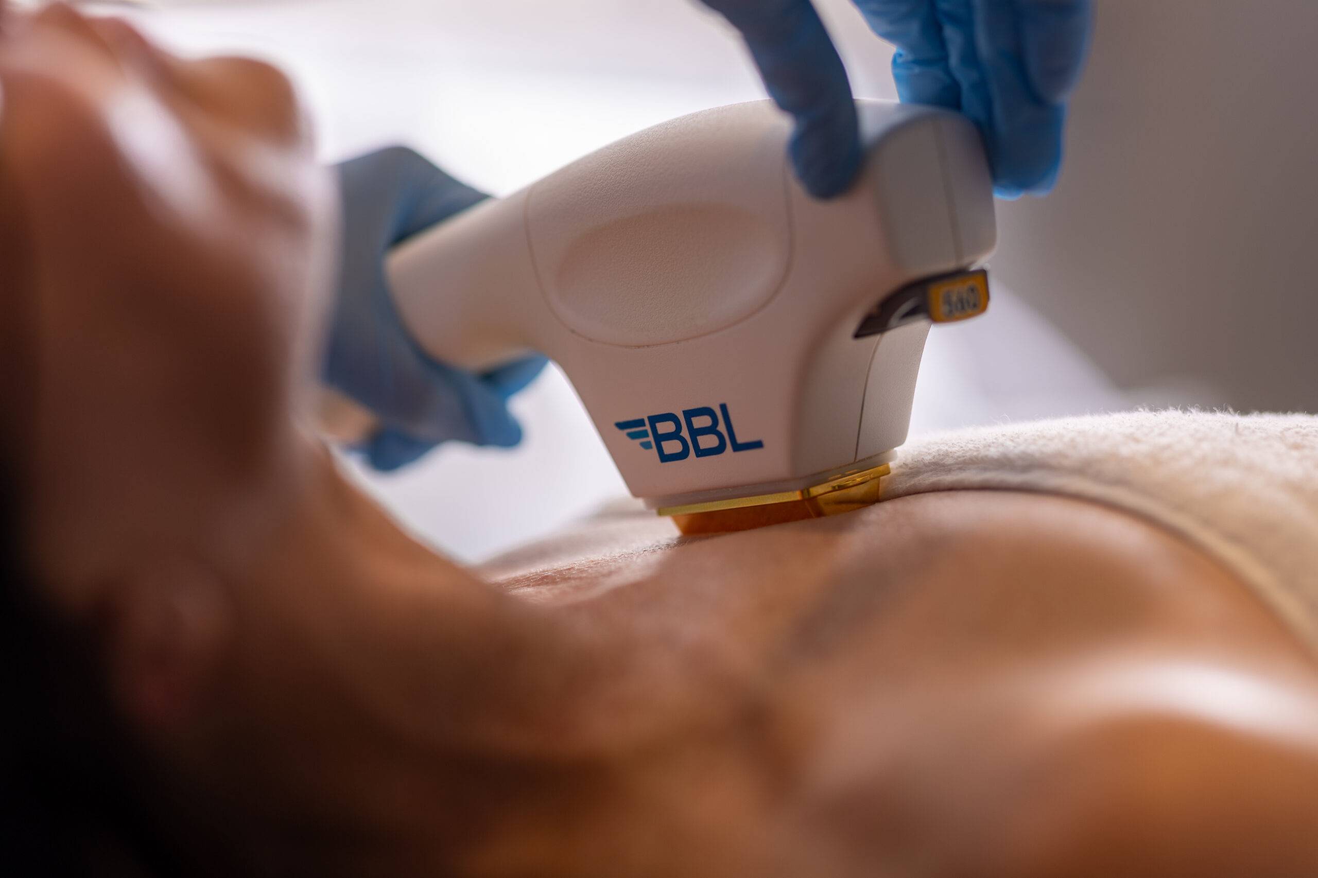 A close-up view of BroadBand Light therapy on a person's face, performed by a practitioner wearing blue gloves. The device is in contact with the skin, suggesting a medical or cosmetic procedure for skin