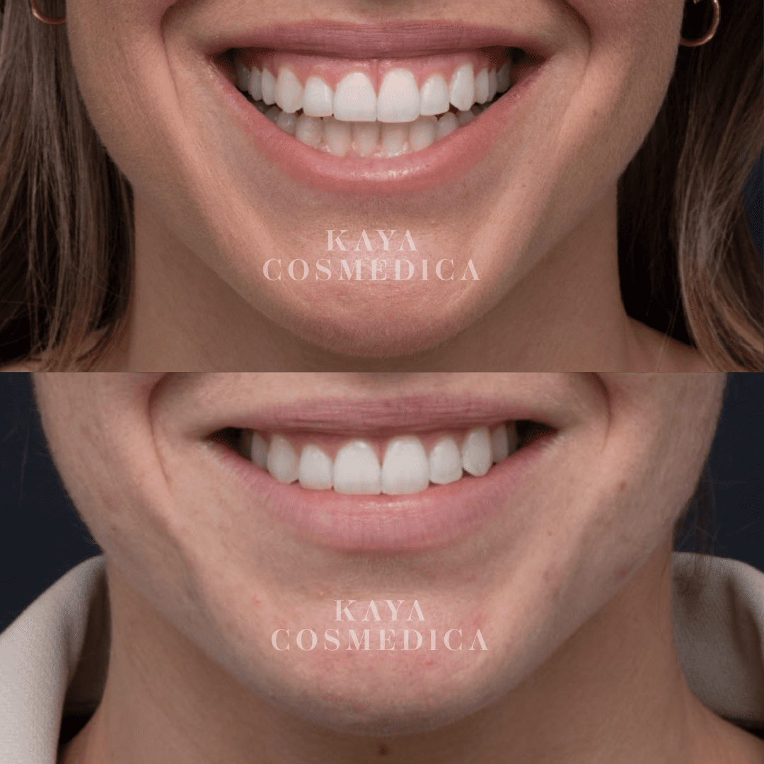 Close-up comparison of a woman's smile before and after dental treatment, with the lower image showing slightly whiter and more aligned teeth. Both images have "Kaya Cosmedica" watermark, showcasing