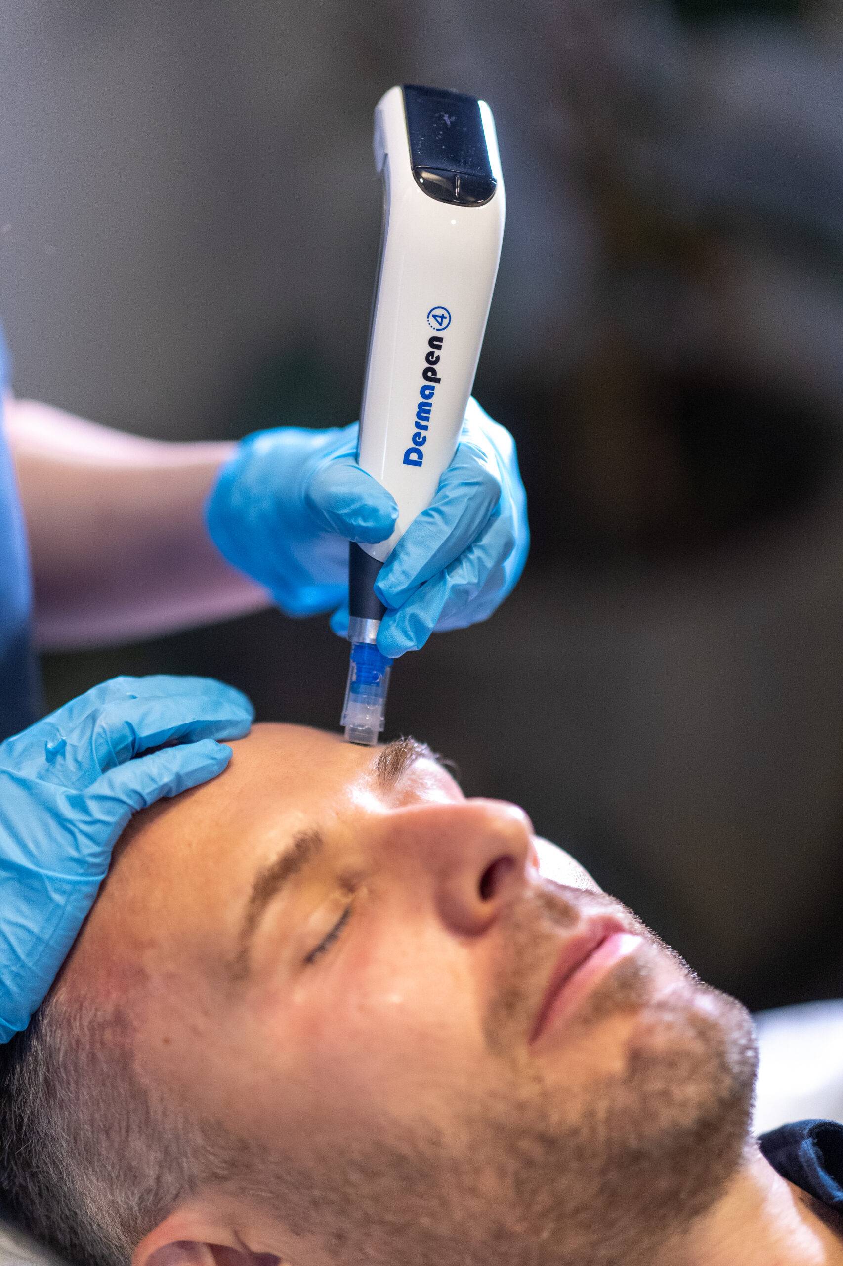 A man reclines with closed eyes while a healthcare professional wearing blue gloves uses a Dermapen 4 on his face, likely during a skin treatment procedure.