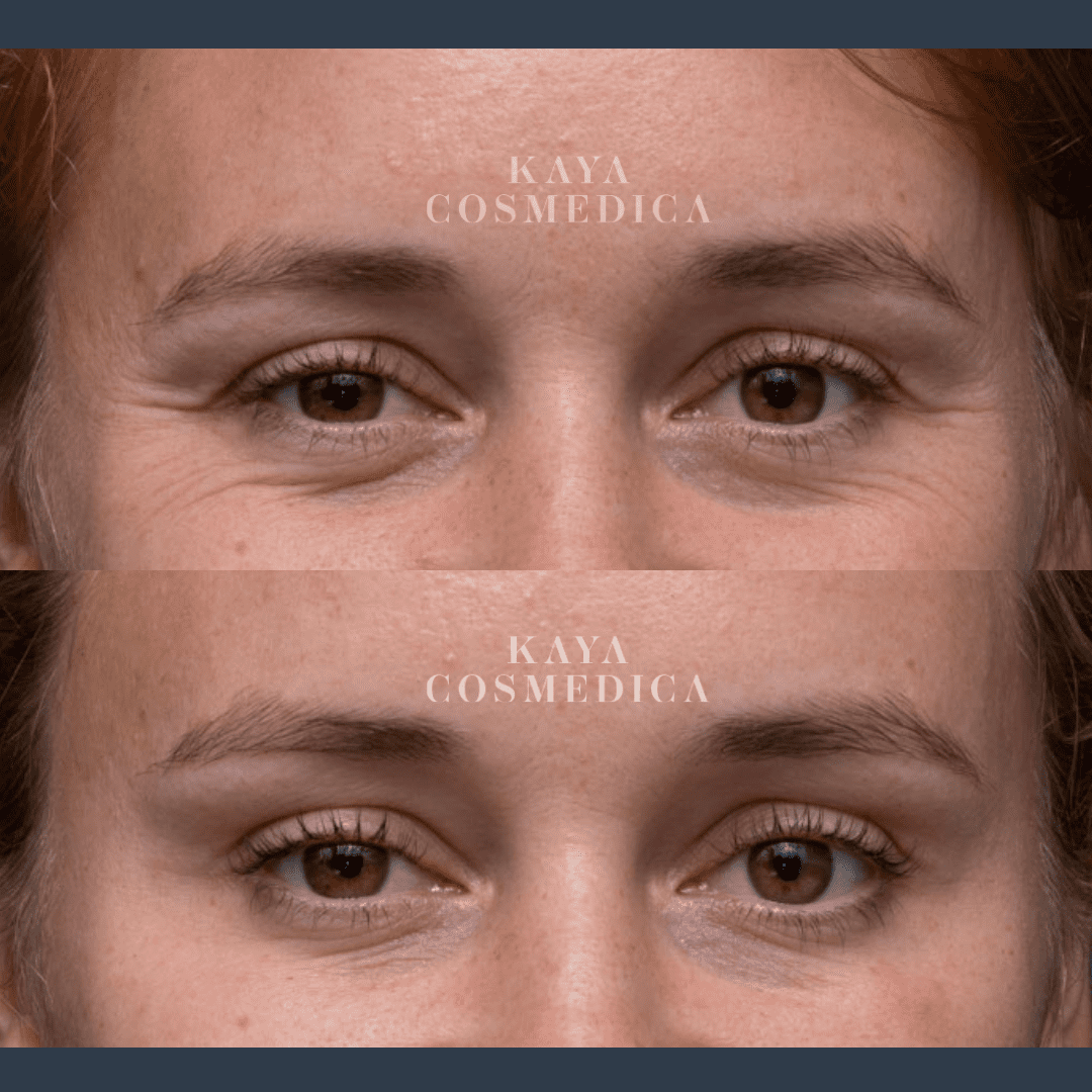 Close-up comparison image of a woman's eyes before and after anti-aging treatment. The top photos show pre-treatment, featuring slight wrinkles, while the bottom photos show smoother skin post-treatment.