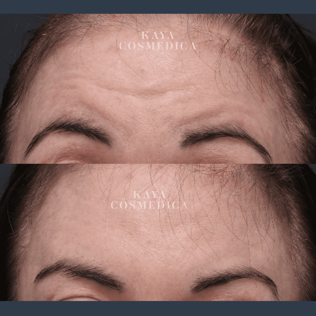 Close-up before and after comparison of a forehead showing anti-wrinkle treatment results. The top image shows visible forehead wrinkles, and the bottom image shows smoother skin. "Kaya Cosmedica