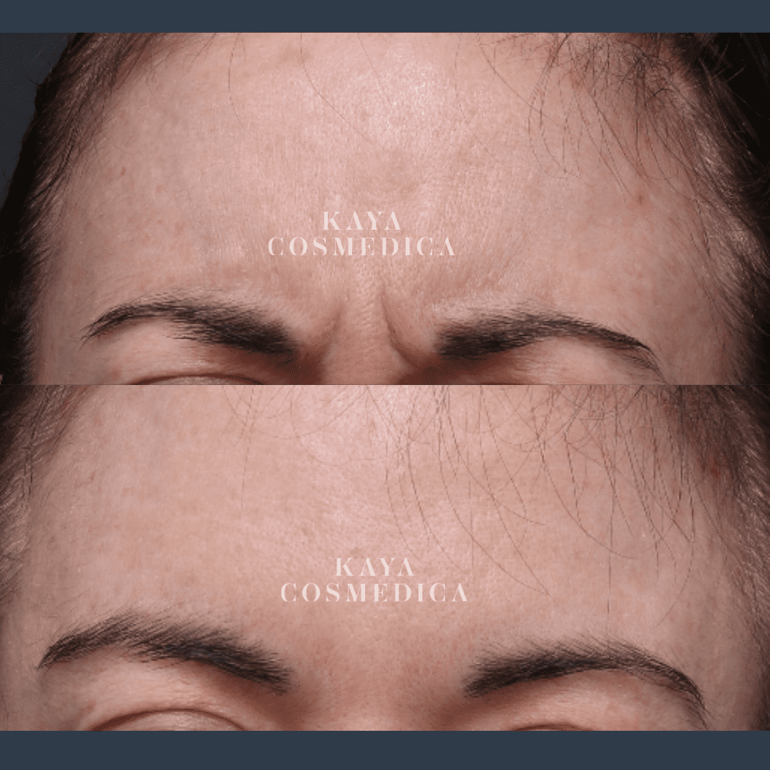 Close-up image showing a comparison of a person's forehead before and after anti wrinkle treatment, highlighting smoother skin and reduced lines in the lower panel, with the logo "kaya cosmedica
