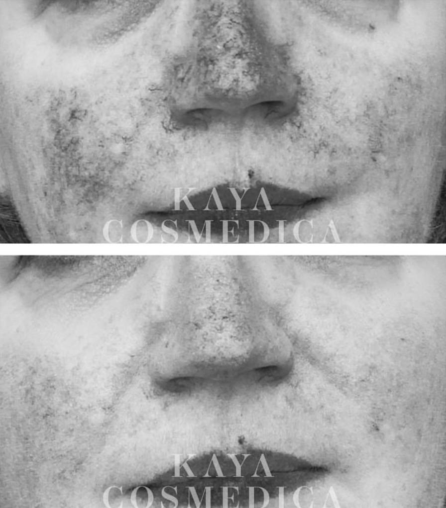 Close-up before and after comparison of a person's nose area, showing improvement in skin clarity from chemical peels. The image has "kaya cosmedica" labeled in the center.