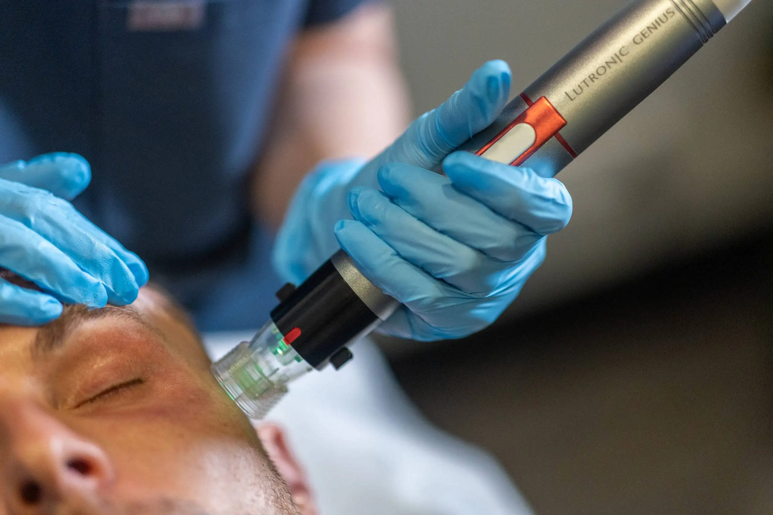 A close-up of a man undergoing an RF Microneedling treatment, focusing on the medical professional's gloved hands using a specialized device on the man's cheek.