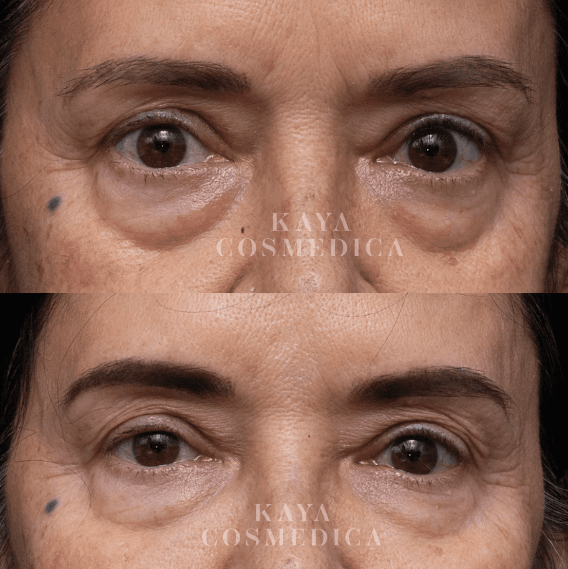Close-up before and after comparison of a woman's eyes, showing reduced wrinkles and diminished dark circles in the lower image. The brand "Kaya Cosmedica" is visible on both images.