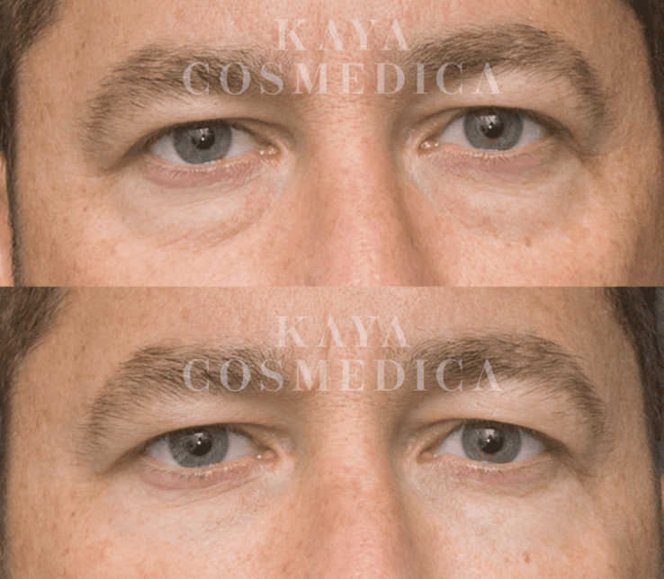 Close-up of a man's eyes, split into two images: the top shows both eyes open, and the bottom shows his right eye partially closed. "kaya cosmedica" is written across
