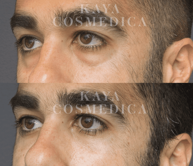 Close-up comparison of a man’s eyes before and after an under-eye treatment, featuring the logo "kaya cosmedica" at the top of each image.