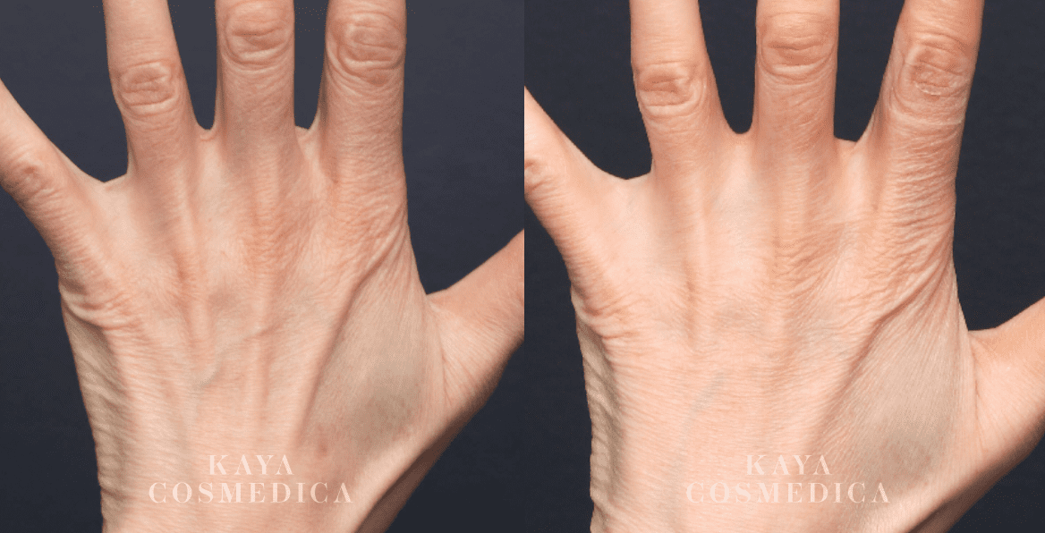Before and after comparison of a hand showing signs of aging such as wrinkles and skin texture, with visible improvement in the skin's appearance in the after image due to hand rejuvenation. Text on the image