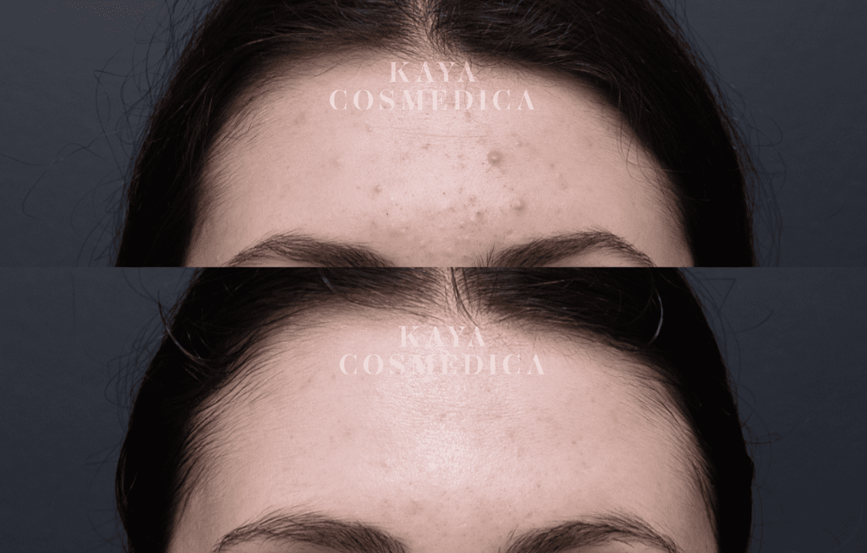 Before and after comparison of a forehead with acne skin treatment results; the top shows visible acne, and the bottom shows clearer skin. Both images have "kaya cosmedica" watermarked.