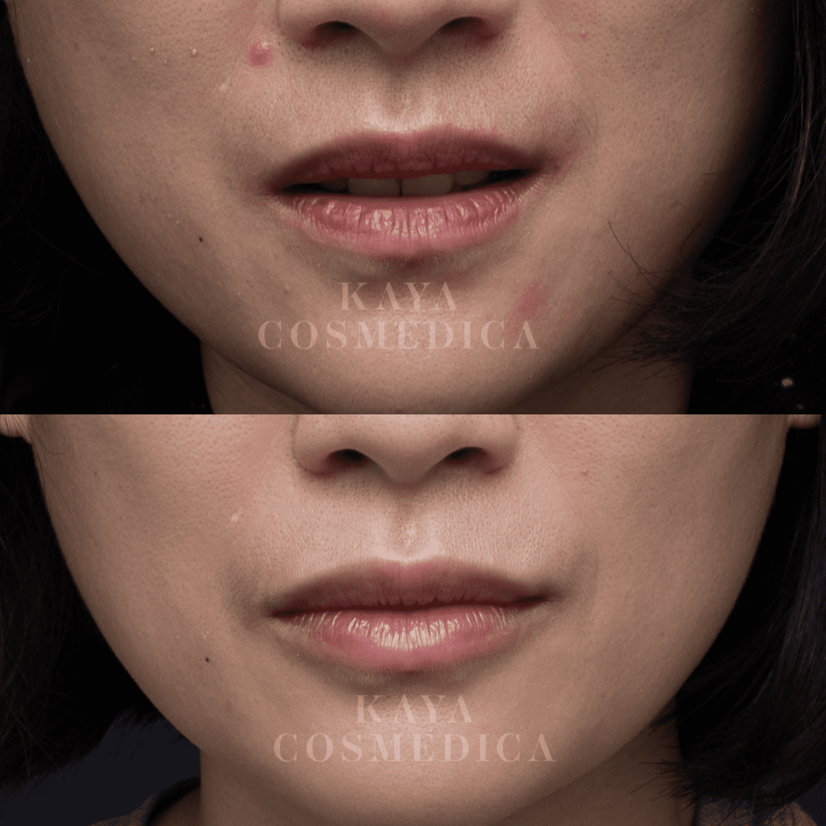 Close-up comparison image of a woman's lips before and after lip augmentation, showing enhanced smoothness and reduced wrinkles post-treatment. The clinic's name, Kaya Cosmedica, is watermarked