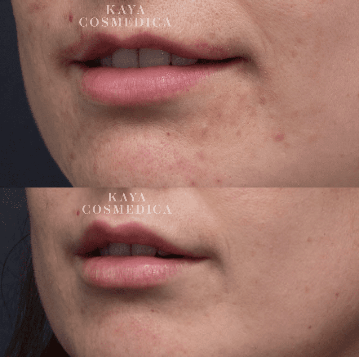 Close-up comparison of a woman's lower face, before and after cosmetic treatment, showing improved skin texture and reduced imperfections around the mouth and chin area, including lip enhancement.