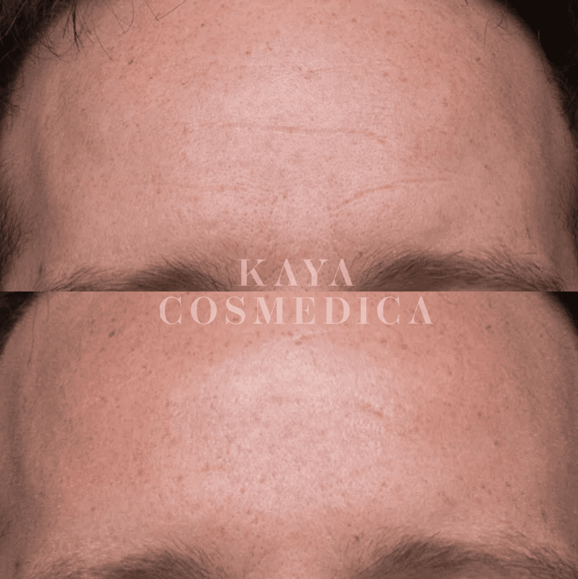 Before and after close-up images of a forehead showing reduced wrinkle appearance due to microneedling, overlaid with text "kaya cosmedica" at the center.