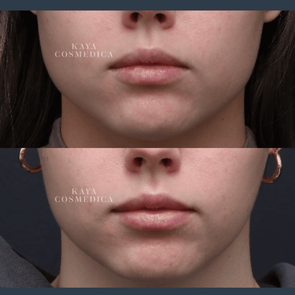 Top and bottom close-up photos of a woman's lower face before and after an anti-wrinkle cosmetic procedure, showing subtle changes in lip fullness, marked with the logo "kaya cosmed