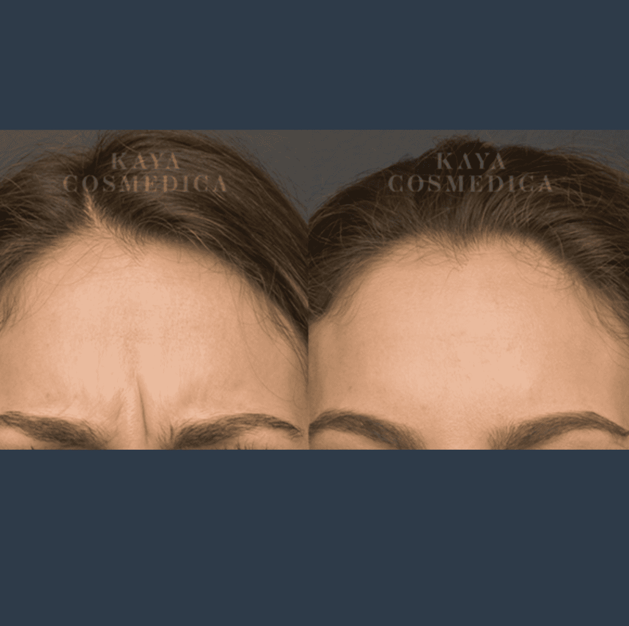 Close-up comparison of a woman's forehead before and after an anti-wrinkle cosmetic treatment, showing smoother skin and reduced wrinkles in the after image. Both images have "Kaya Cosmedica