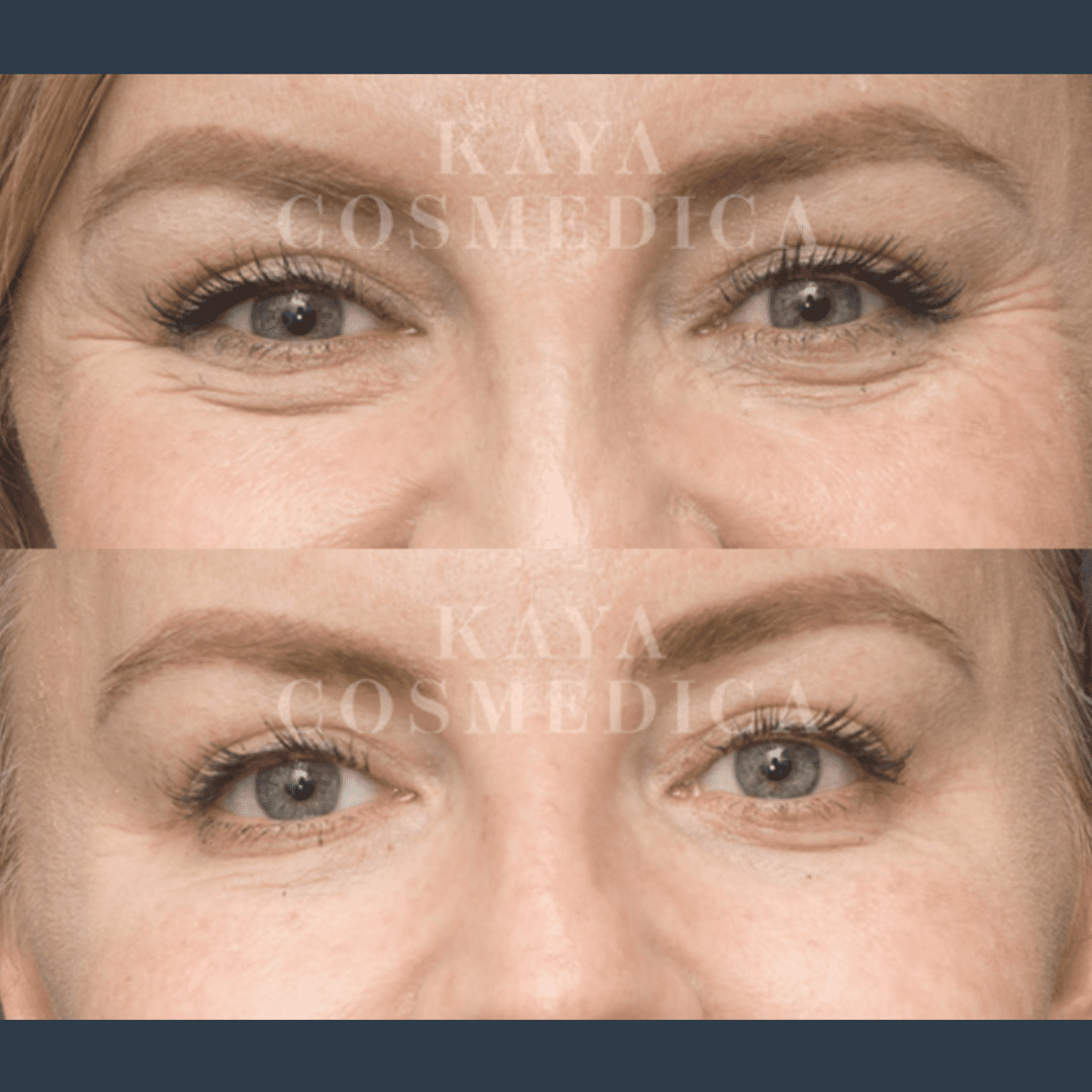 Close-up comparison of a woman's eyes before and after anti-wrinkle treatment, showcasing differences in skin texture and eye appearance, with the logo "kaya cosmedica" at the center.