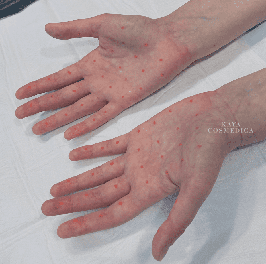 Two hands displayed palms-up on a light-colored surface, showing numerous small red spots or dots scattered across the skin. The image also includes a watermark label at the bottom center, "kaya cosmed
