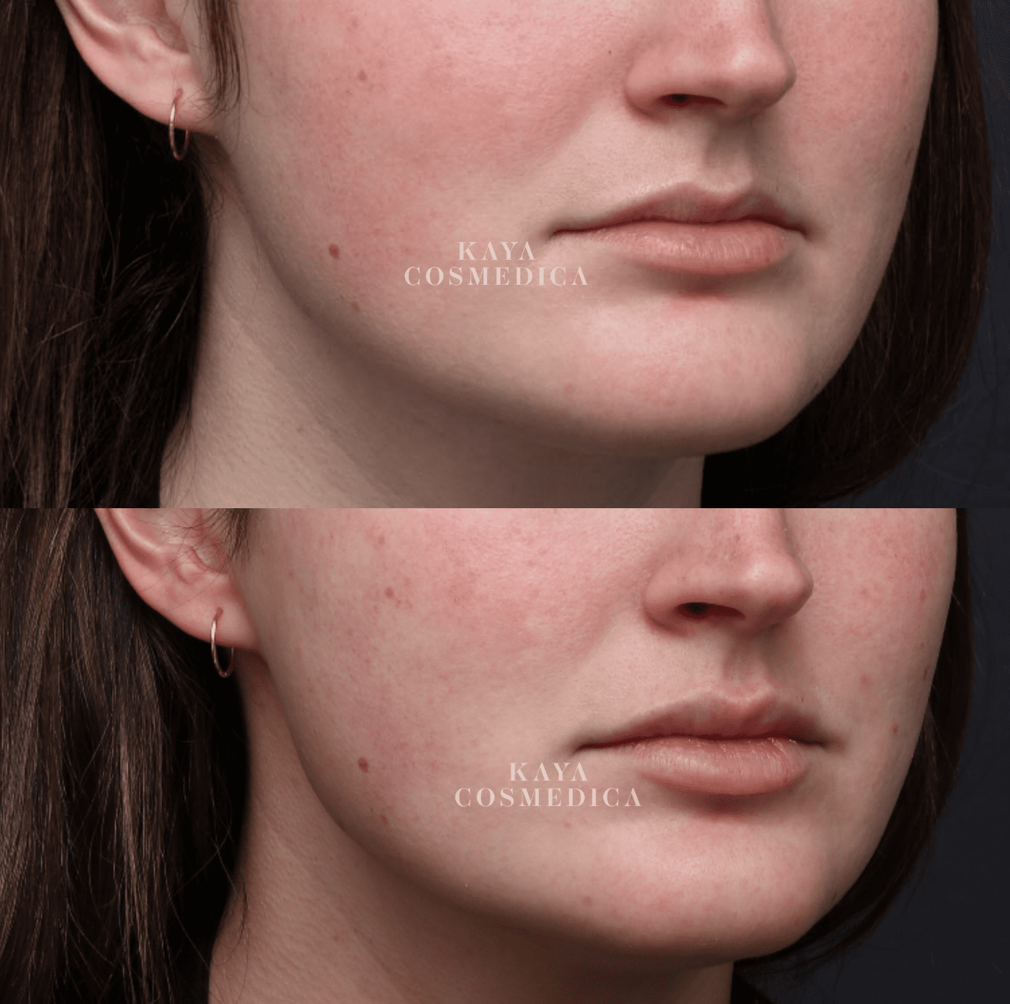 Before and after close-up images of a woman's lower face showing improvement in lip enhancement and skin texture. The photos are labeled "Kaya Cosmedica.