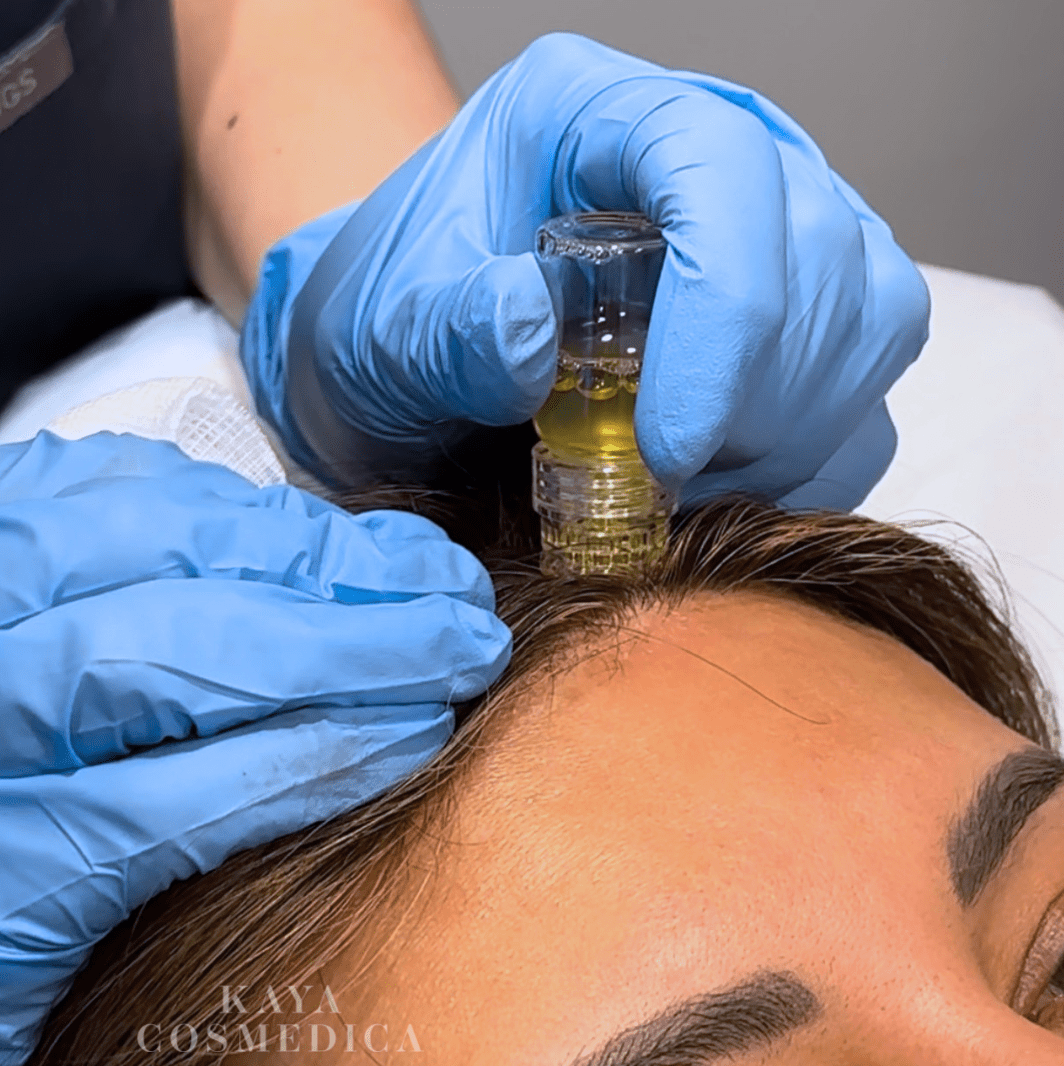Aesthetic professional wearing blue gloves uses a microneedling device on a client's forehead during a hair loss treatment. The tool appears to dispense a yellowish serum.